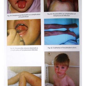 Manual of Children's Infectious Diseases